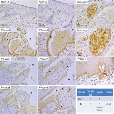 Oxidative Stress-Mediated YAP Dysregulation Contributes to the Pathogenesis of Pemphigus Vulgaris